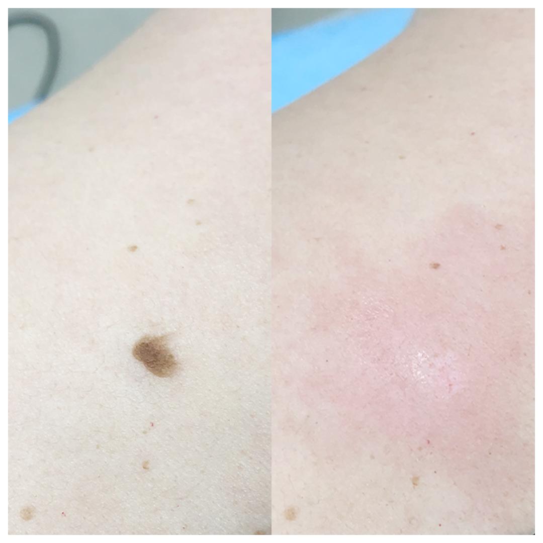 видалення родимок - Київ